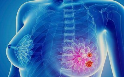 La inteligencia artificial podría detectar el cáncer de mama 4 años antes de formarse