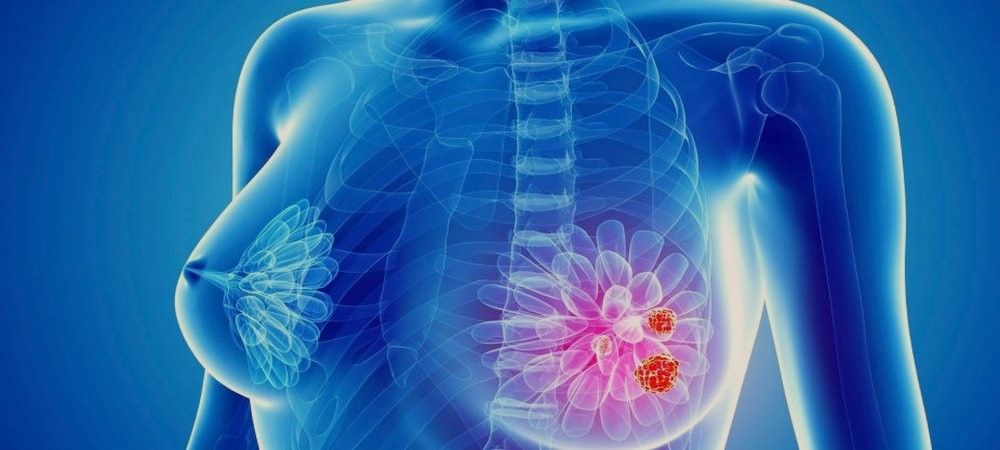 La inteligencia artificial podría detectar el cáncer de mama 4 años antes de formarse