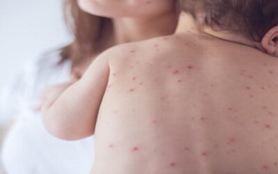 Bolivia con 86 casos de sarampión: Recomiendan evitar viajes de menores para evitar la propagación