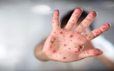 Bolivia aquejada por una ola de sarampión, el control parece que se escapa de las manos